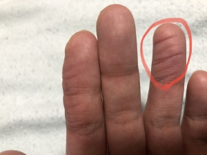 薬指セーハ後の状態